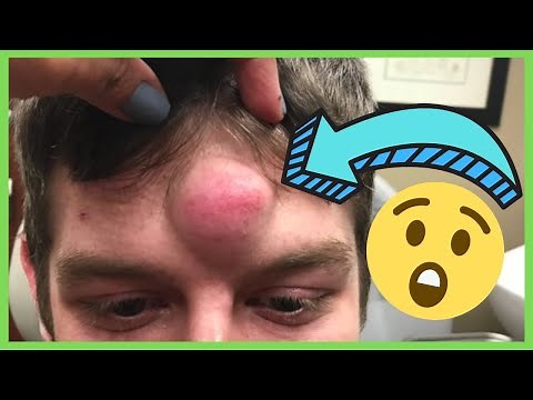 How To Pop A Pimple Without Leaving A Scar | 6 Tips For Success