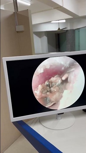 Deep Ear Canal Cleaning 👂 | Incredible Wax Build-Up Gone #ENTClinic #Health #Viral