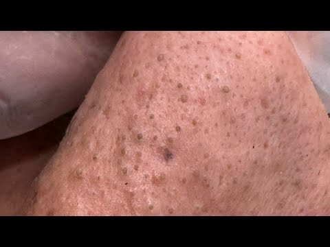 Deep Pore Cleansing And Blackhead Removal | Korean Skincare Routine