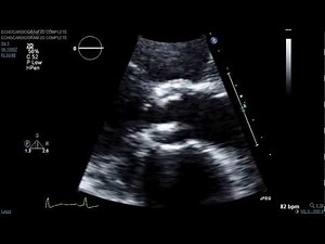 Brown Clinical Image of the Month: Lambls Echo 3