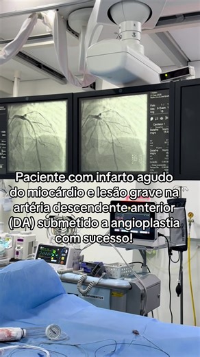 Infarto agudo do miocárdio e lesão grave na artéria descendente anterior (DA) submetido a angioplastia com sucesso! #angioplastia #infarto #Enfermagem