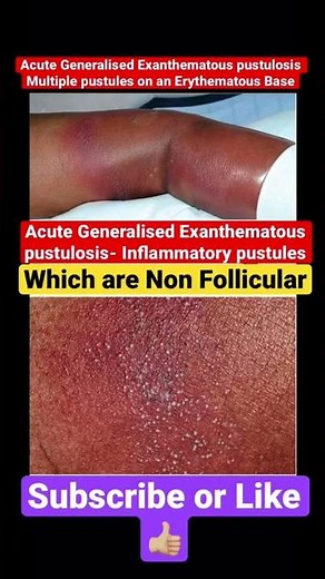 Acute Generalised Exanthematous pustulosis Multiple pustules on an Erythematous Base