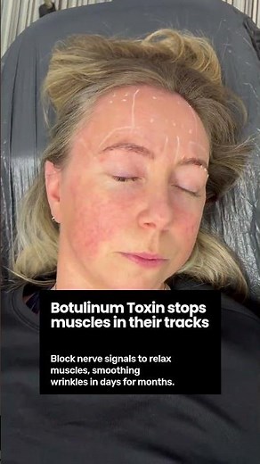 Understanding Botulinum Toxin Mechanism