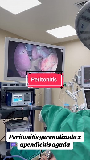 Cirugía de Apendicitis y Peritonitis | Procedimiento Médico Detallado