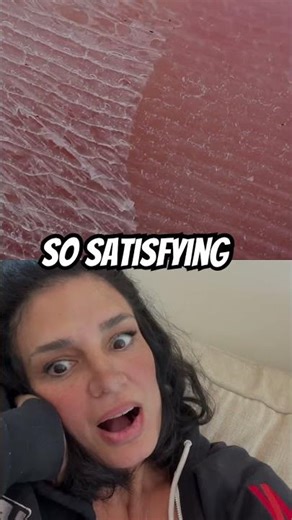 Peeling skin so satisfying #chemicalpeels
