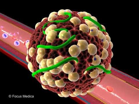Renal artery stenosis - Nephrology
