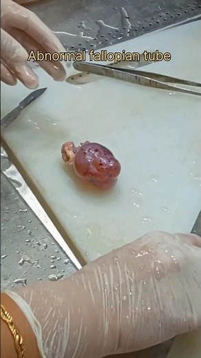 Abnormal fallopian tube biopsy 🧐