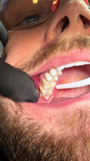 Upper wisdom tooth extraction. #dentistry #students #extraction #wisdomteeth #implants