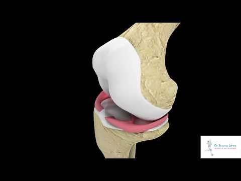 Dr Bruno Lévy - Anse de seau du ménisque