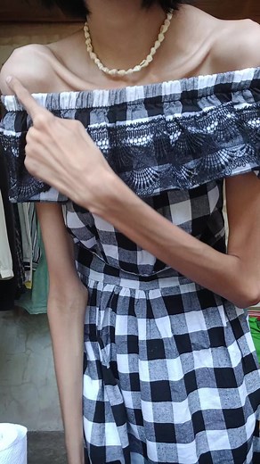 Cindy's Scoliosis Journey: Embracing Her Look