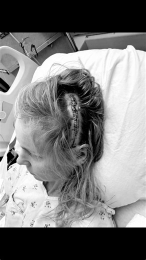 5.9K views · 299 reactions | I had brain surgery 3 weeks ago. A bleed...