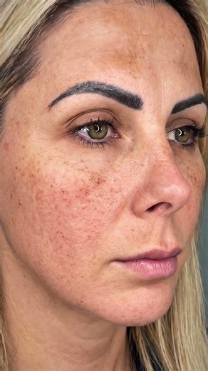 Dites adieu au mélasma Découvrez notre protocole exclusif My Laser x Dermamelan, conçu en