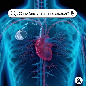 108 reactions · 13 shares | Las indicaciones para la colocación de un marcapasos son numerosas (ver tabla) pero generalmente implican bradicardia sintomática o bloqueo auriculoventricular de alto grado (bloqueo AV). Refresque sus conocimientos: https://msdmnls.co/42gR1zR | Manuales de MSD Profesionales | Facebook