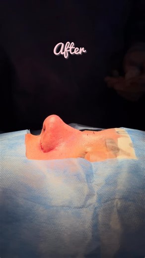 Dr. Herrera Rivera Mariano/ENT on Instagram: "The rhinoplasty is a surgery that change the structure of the nose, changing for an aesthetic looking. It’s simply amazing art👃🏻🔥#rhinoplastyexpert #rhinoplastydiary #rhinoplastysurgeon #naturalrhinoplasty #facialaesthetics ✅ Schedule an appointment with Dr. Herrera Rivera, at his Private Clinic for surgery or assessment: ✅ Agendar una cita con el Dr. Herrera Rivera, en su Clinica Privada para cirugía o valoración: Cofepris: 2502022002A00196 atten