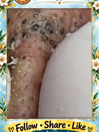 Deep Blackhead Extraction & Satisfying Popping | Wait for the most satisfying pop 😳🫣 You won’t believe what comes out! #pimplepoppersatisfying #Acne #pimple #Blackhead #Satisfying