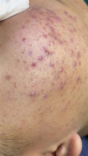 The appearance, with its dense patches of inflammation on the face, is captivating and impossible to ignore #acne #acneproneskin #spa #beauty #foryou