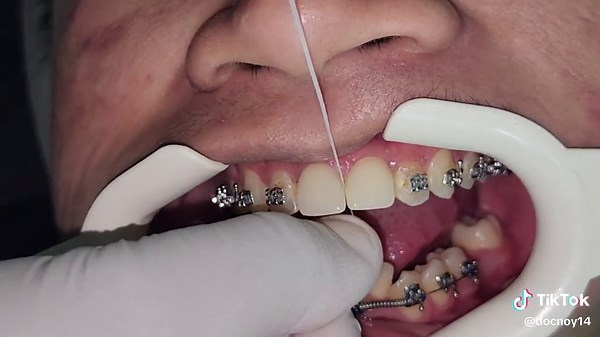 Plastic Jacket Crown and Braces Procedure Explained