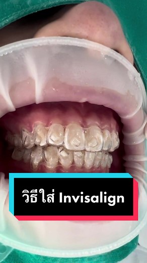 วิธีใส่ #Invisalign 🔥 #หมอเชษฐ์ #smileboxclinic #จัดฟันใสinvisalignต้องsmilebox #คลินิกทันตกรรมสไมล์บ็อกซ์ #จัดฟันที่smilebox #จัดฟันที่ไหนดี #tiktokuni #รักสุขภาพ #invisalignth #จัดฟันใสinvisalign