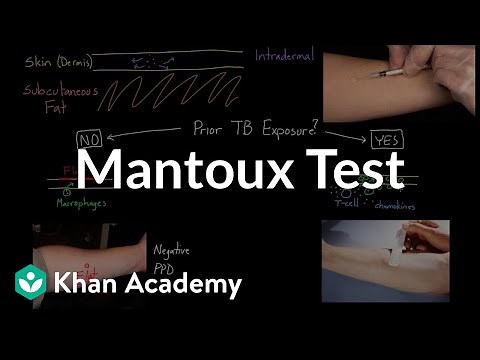 Mantoux test (aka. PPD or TST) | Infectious diseases | NCLEX-RN | Khan Academy