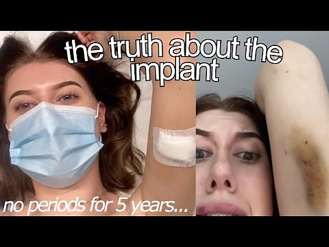 getting my implant removed AND REPLACED after 5 years (my experience)
