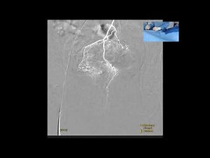 Live Hemorrhoid Embolization Case
