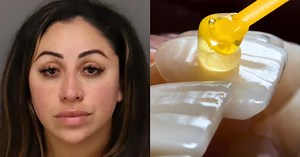Fake Dentist Jailed After Allegedly Using Super Glue to Give People Veneers