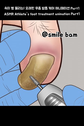 Smile Bam Animation ASMR Care for Athlete's Foot