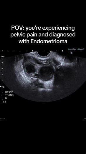 Multiple round hypoechoic densities are shown within both ovaries and demonstrate intermediate echogenecity. The largest of these on the right measures 3.5cm, the largest on the left measure 2.6cm. The uterus is normal in size and echogenecity l. It is anteverted and mobile. #ultrasound #health #women #fyp #tiktokhealth #foryoupage #foryougirls #cyst #techtok