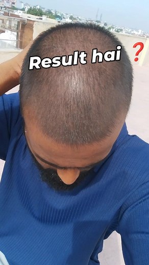 vikash kannaujiya | Mere secret formula ka Result hai bhai na ki zamal khote ka 😊 #hairfall #hairregrowthtreatment #hairloss #hairregrowth #hairfalltreatment... | Instagram
