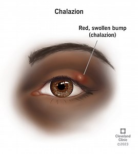 What Is a Chalazion?