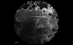 【荧光素血管造影】【FFA】【脉络膜视网膜吻合/新生血管】Real-Time Fluorescein Angiography
