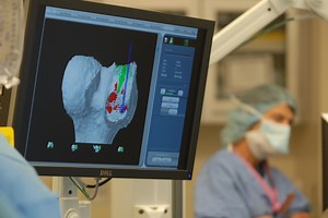 Partial Knee Replacement by Top Orthopedic Surgeons in Baltimore