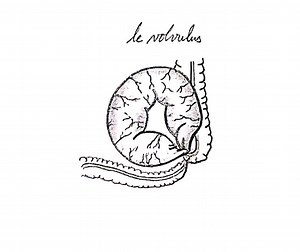 L'occlusion intestinale : classifications mécanismes physiopathologie diagnostic et traitement