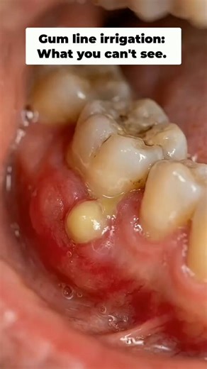 Teeth infection explodes