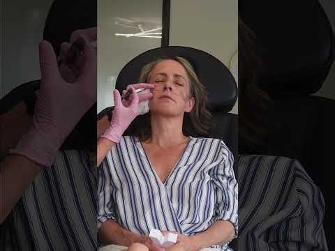 Advanced Filler Technique: Structure First for Natural Results