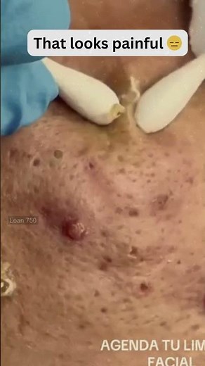 Large Blackheads Extraction Big Cystic Acne Blackheads&Whiteheads Removal Pimple Popping #1112 2026