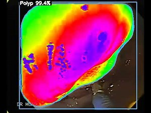 SpectraAI Polyp Detection