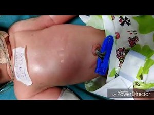 Silverman Anderson Score and Downe's Score | Pediatrics