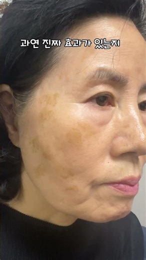 How to completely get rid of freckles and blemishes!? #kbeauty #review #howtoget ridoffreckles #f...