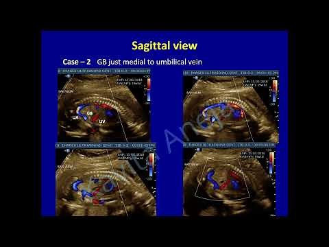 Umbilical - portal venous system and Persistent right umbilical vein