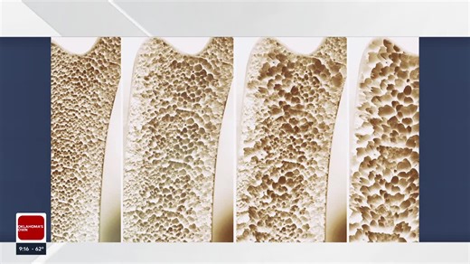 What to know about osteoporosis risk, prevention and treatment