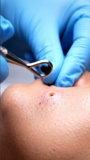 “The Most Satisfying Blackhead Pop Ever! 🤯✨”