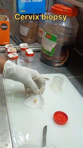 Cervical biopsy for screening cervical cancer | #histopathology #cervicalcancer #cervicaltreatment