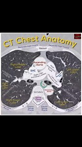 #CTChest #anatomy #CTscan #chest #CT | CT Scan and MRI study