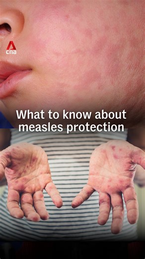 Two doses of the measles, mumps and rubella (MMR) vaccine after 12 months of age are needed for long-term protection against measles. If you’re unsure whether you’re fully vaccinated, doctors can check your records or test for immunity, especially before travelling, said Associate Professor Lim Poh Lian of the Communicable Diesases Agency on Friday (Feb 6). Symptoms of measles include fever, rash that starts on the face, cough, runny nose, and red or watery eyes. Singapore is stepping up public 