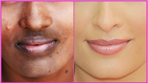 How To Remove Dark Black Patches, Dark Spots,Hyper Pigmentation Around Your Mouth | Uneven Skin Tone | Indian Beauty Secrets