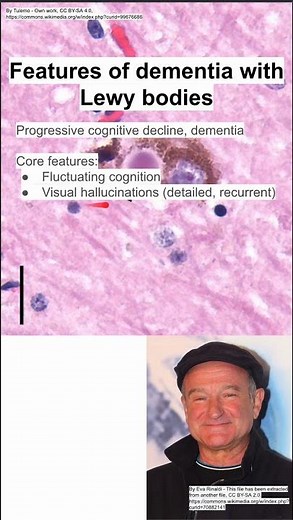 Features of dementia with Lewy bodies