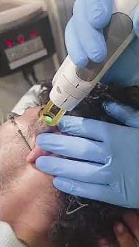 Venous malformation treated with combination of Pulsed Dye Laser and Long Pulsed ND: YAG laser