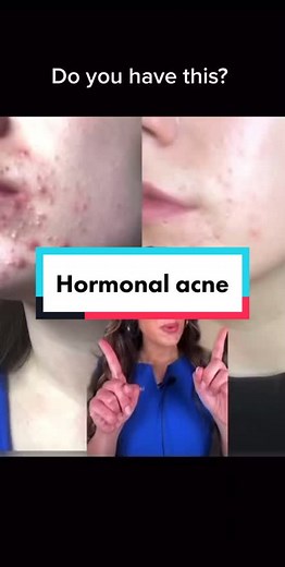 Understanding Hormonal Acne in Adult Women