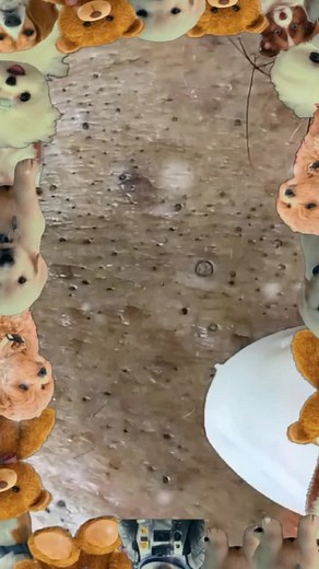 limpeza de pele satisfatória. #limpezadepele #satisfatório #pimple #foryou #vaiprofy #fypp